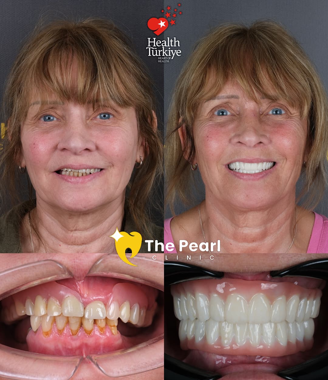 Full arch dental implant smile transformation